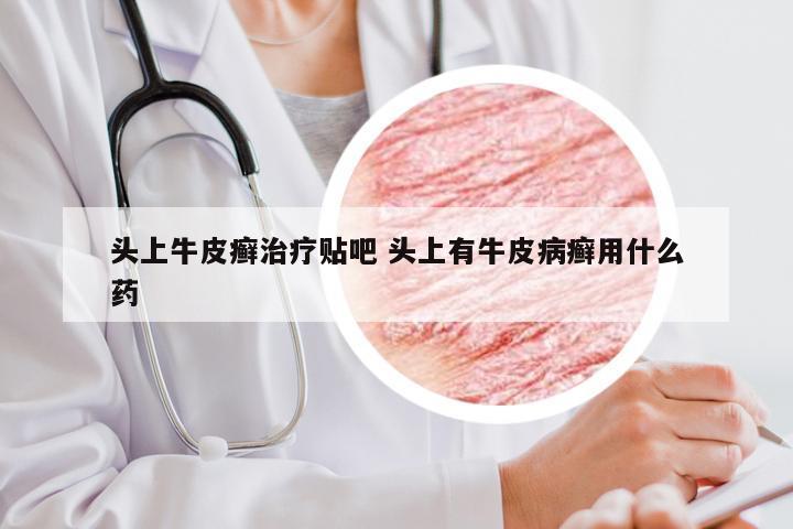 头上牛皮癣治疗贴吧 头上有牛皮病癣用什么药