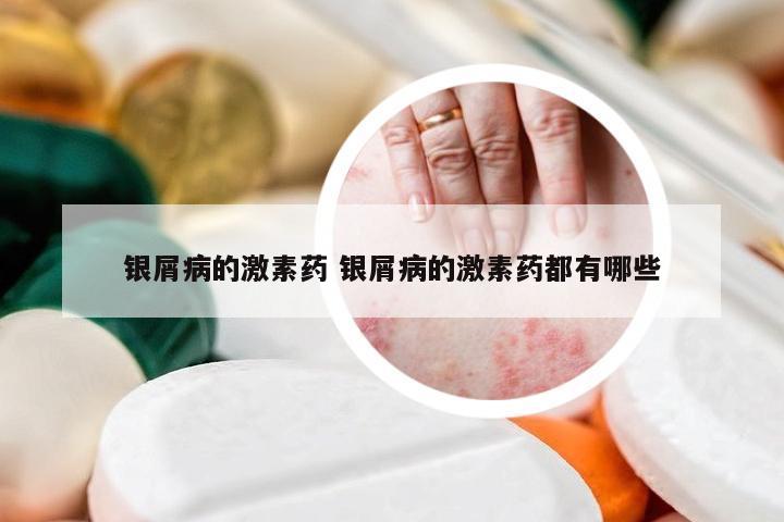 银屑病的激素药 银屑病的激素药都有哪些