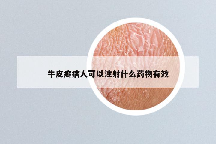 牛皮癣病人可以注射什么药物有效