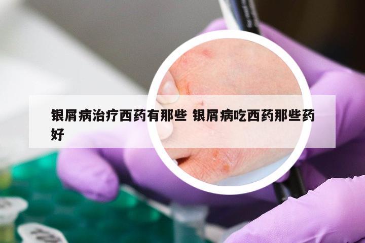 银屑病治疗西药有那些 银屑病吃西药那些药好