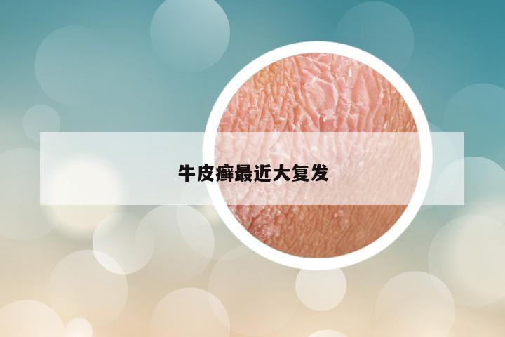 牛皮癣最近大复发