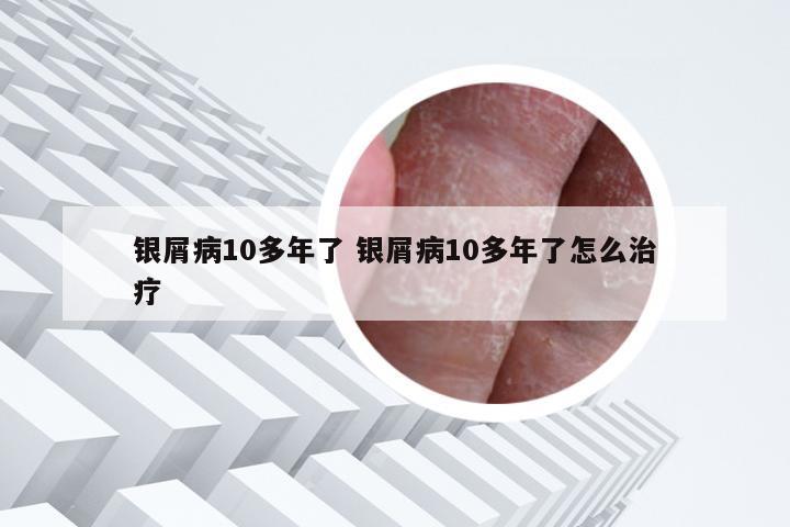 银屑病10多年了 银屑病10多年了怎么治疗