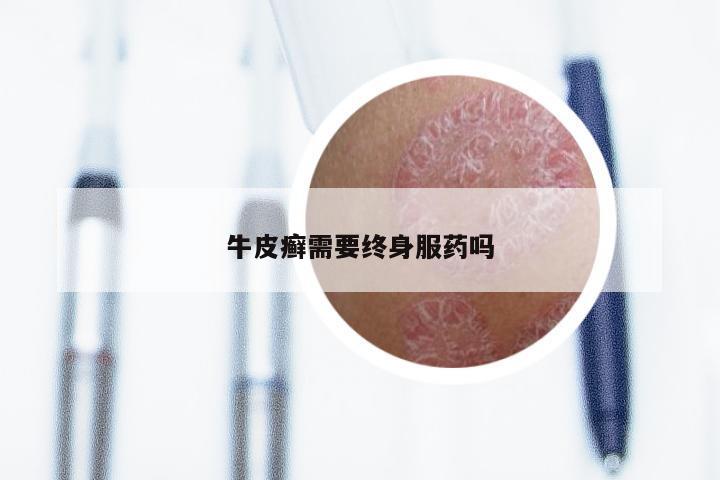 牛皮癣需要终身服药吗