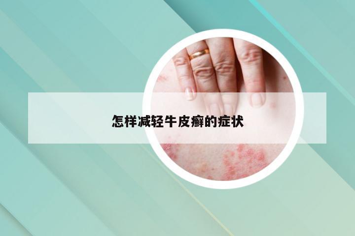 怎样减轻牛皮癣的症状