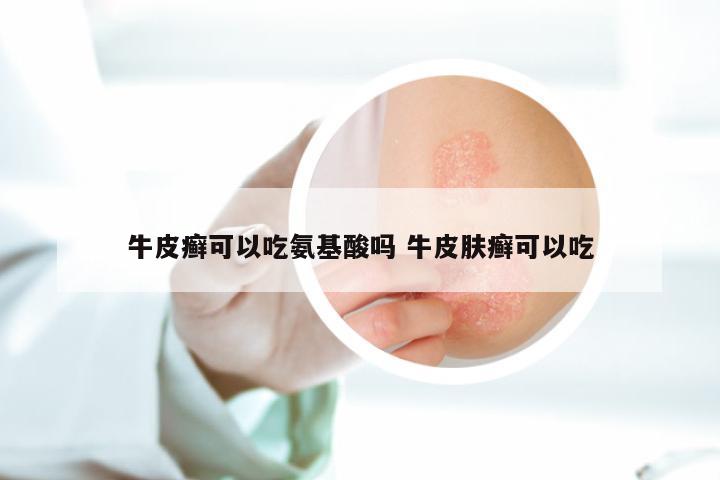 牛皮癣可以吃氨基酸吗 牛皮肤癣可以吃