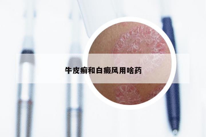牛皮癣和白癜风用啥药