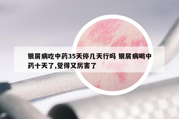 银屑病吃中药35天停几天行吗 银屑病喝中药十天了,觉得又厉害了