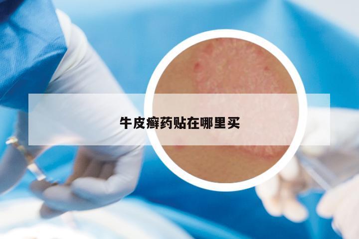 牛皮癣药贴在哪里买