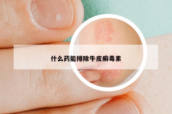 什么药能排除牛皮癣毒素