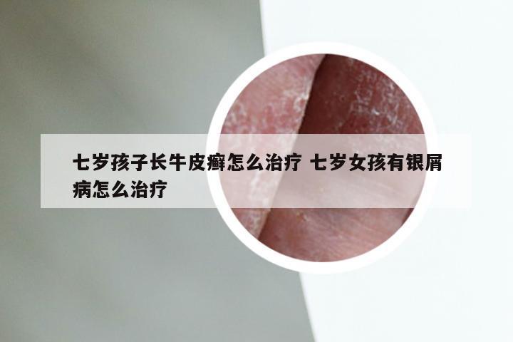 七岁孩子长牛皮癣怎么治疗 七岁女孩有银屑病怎么治疗