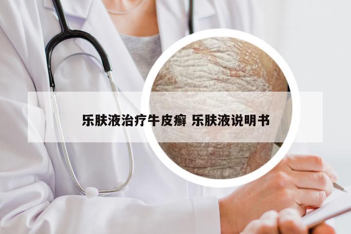 乐肤液治疗牛皮癣 乐肤液说明书