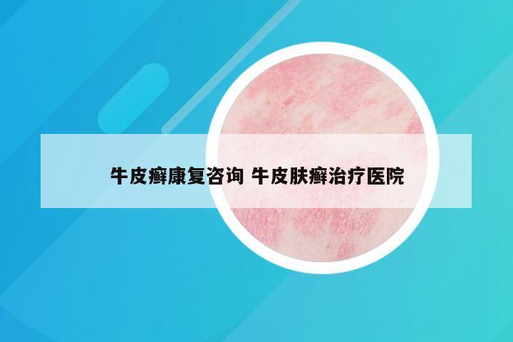 牛皮癣康复咨询 牛皮肤癣治疗医院