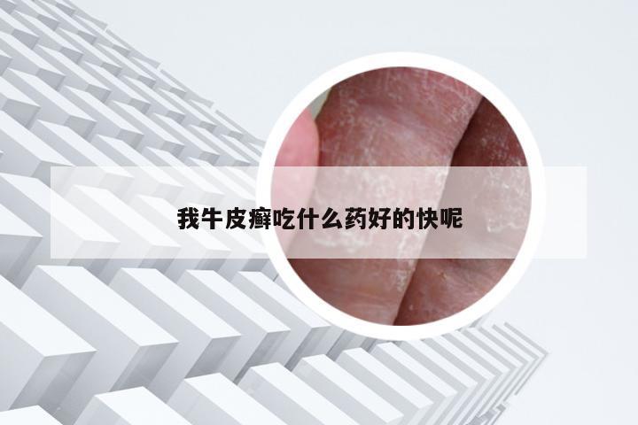 我牛皮癣吃什么药好的快呢