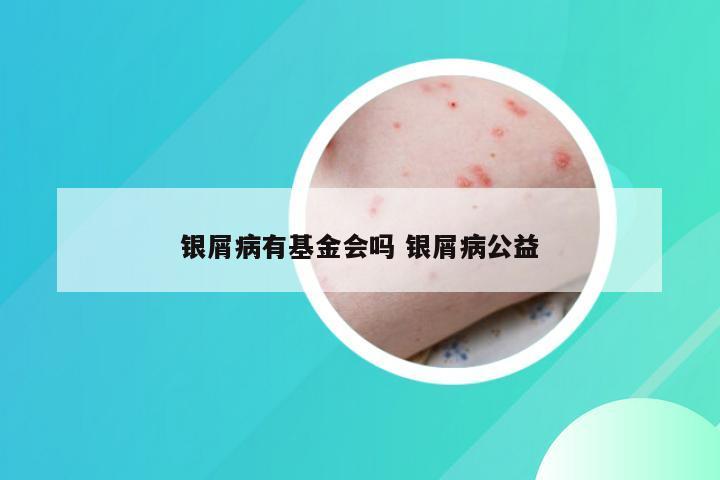 银屑病有基金会吗 银屑病公益