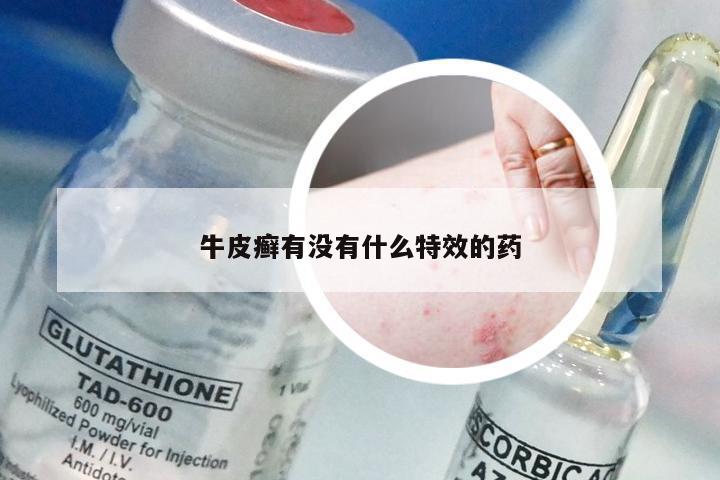 牛皮癣有没有什么特效的药