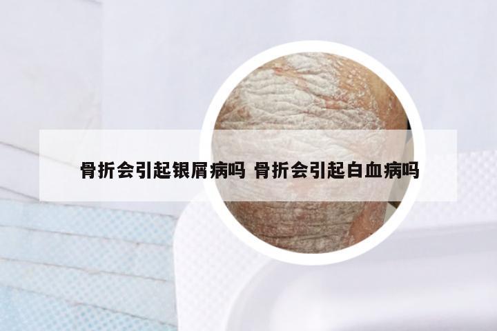 骨折会引起银屑病吗 骨折会引起白血病吗