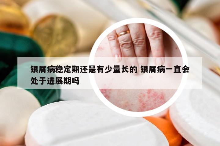银屑病稳定期还是有少量长的 银屑病一直会处于进展期吗