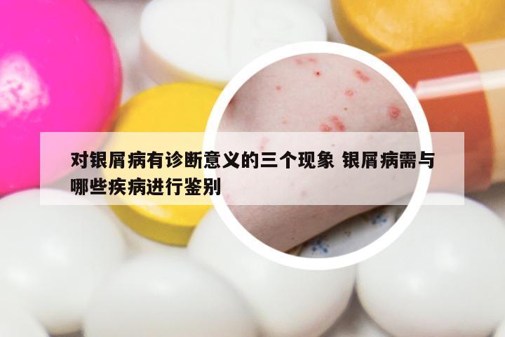 对银屑病有诊断意义的三个现象 银屑病需与哪些疾病进行鉴别