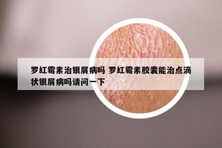罗红霉素治银屑病吗 罗红霉素胶囊能治点滴状银屑病吗请问一下