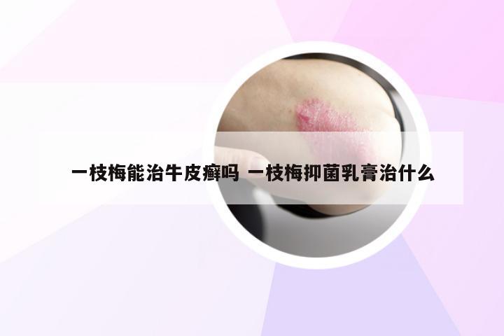 一枝梅能治牛皮癣吗 一枝梅抑菌乳膏治什么
