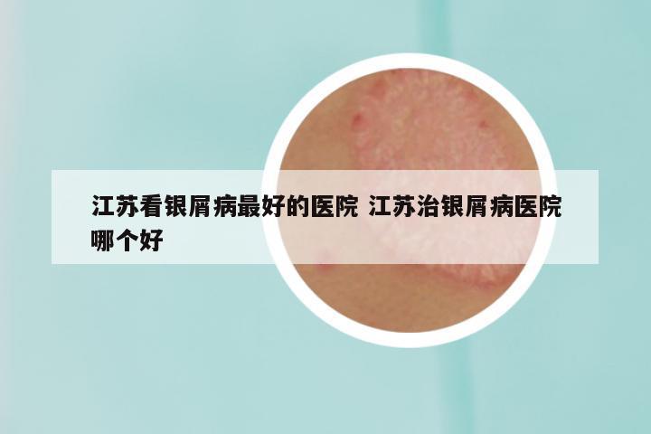 江苏看银屑病最好的医院 江苏治银屑病医院哪个好