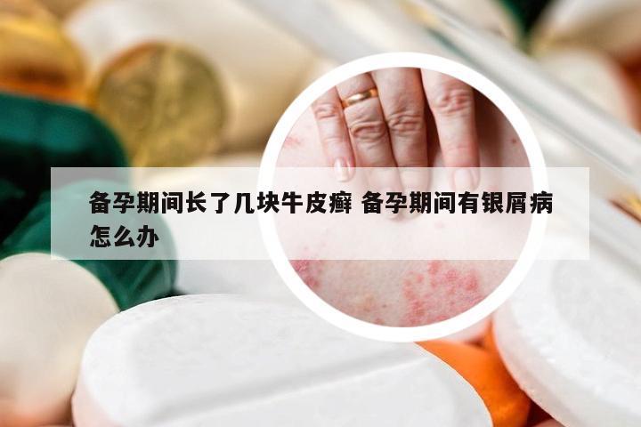备孕期间长了几块牛皮癣 备孕期间有银屑病怎么办