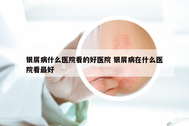 银屑病什么医院看的好医院 银屑病在什么医院看最好