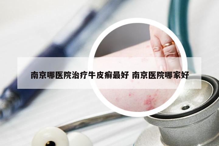 南京哪医院治疗牛皮癣最好 南京医院哪家好