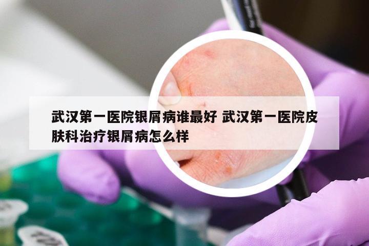 武汉第一医院银屑病谁最好 武汉第一医院皮肤科治疗银屑病怎么样