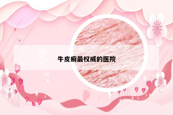 牛皮癣最权威的医院