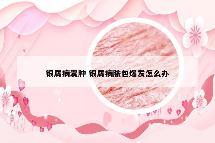 银屑病囊肿 银屑病脓包爆发怎么办