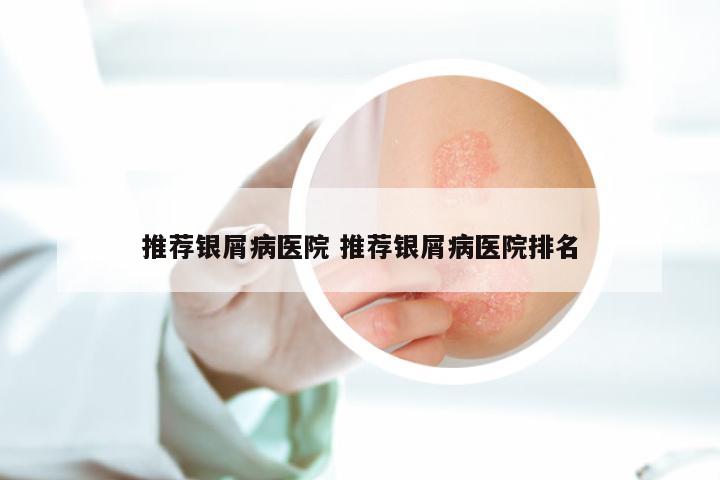 推荐银屑病医院 推荐银屑病医院排名