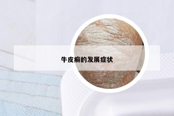 牛皮癣的发展症状