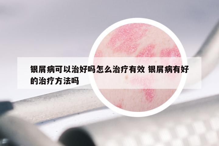 银屑病可以治好吗怎么治疗有效 银屑病有好的治疗方法吗