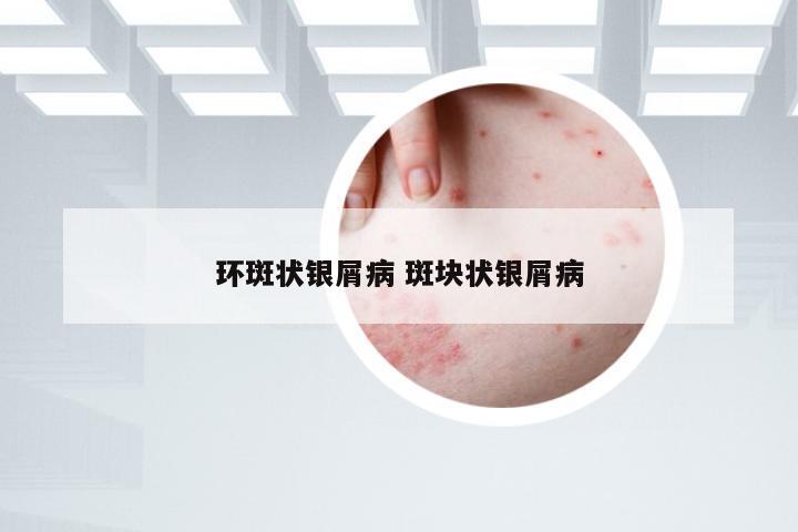 环斑状银屑病 斑块状银屑病
