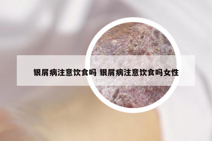 银屑病注意饮食吗 银屑病注意饮食吗女性