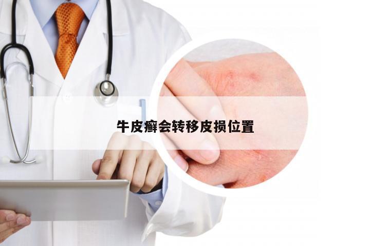 牛皮癣会转移皮损位置