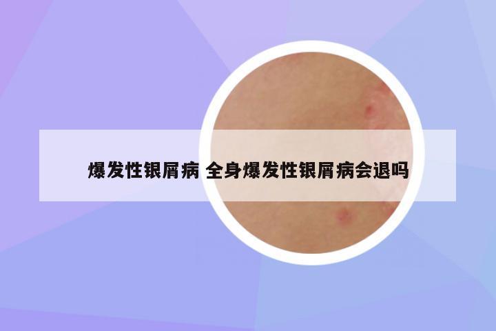 爆发性银屑病 全身爆发性银屑病会退吗