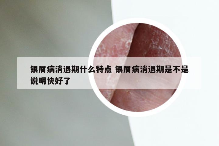 银屑病消退期什么特点 银屑病消退期是不是说明快好了