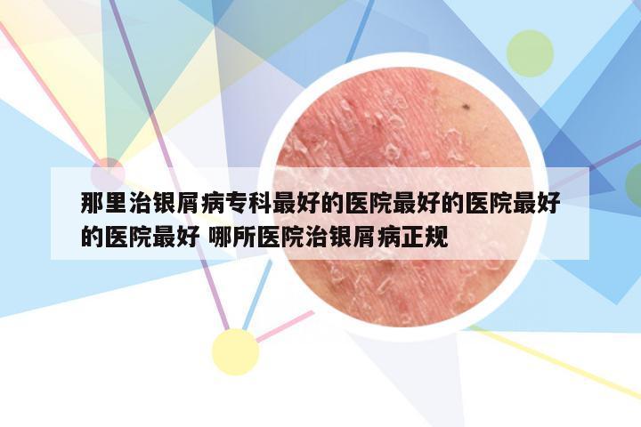 那里治银屑病专科最好的医院最好的医院最好的医院最好 哪所医院治银屑病正规