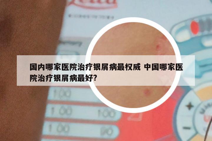 国内哪家医院治疗银屑病最权威 中国哪家医院治疗银屑病最好?