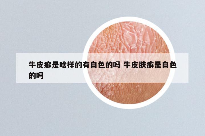 牛皮癣是啥样的有白色的吗 牛皮肤癣是白色的吗