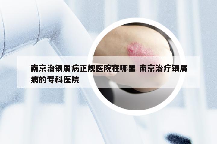 南京治银屑病正规医院在哪里 南京治疗银屑病的专科医院