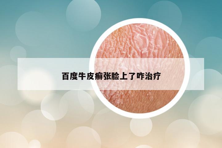 百度牛皮癣张脸上了咋治疗