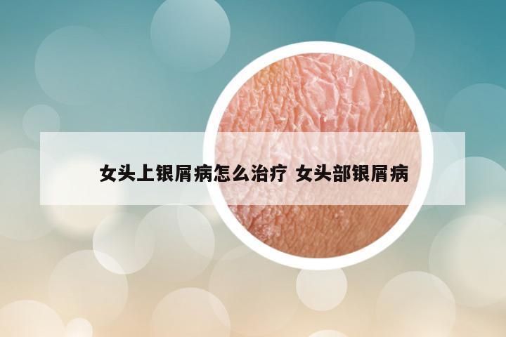 女头上银屑病怎么治疗 女头部银屑病