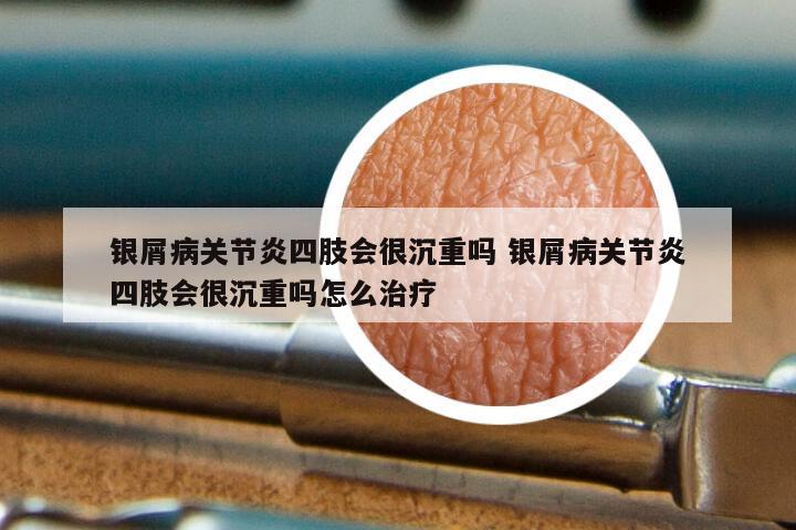 银屑病关节炎四肢会很沉重吗 银屑病关节炎四肢会很沉重吗怎么治疗
