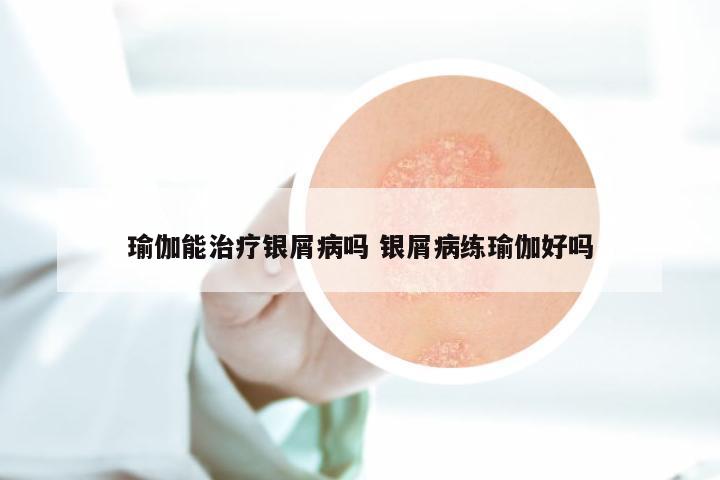 瑜伽能治疗银屑病吗 银屑病练瑜伽好吗