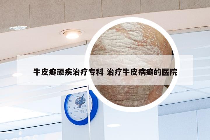 牛皮癣顽疾治疗专科 治疗牛皮病癣的医院