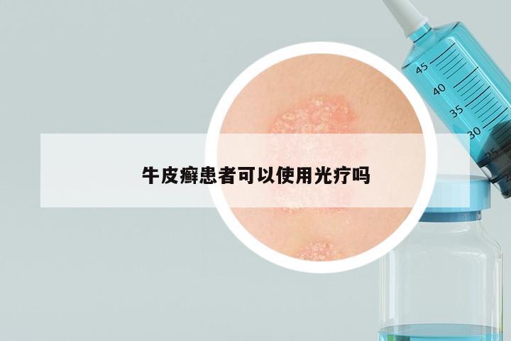 牛皮癣患者可以使用光疗吗