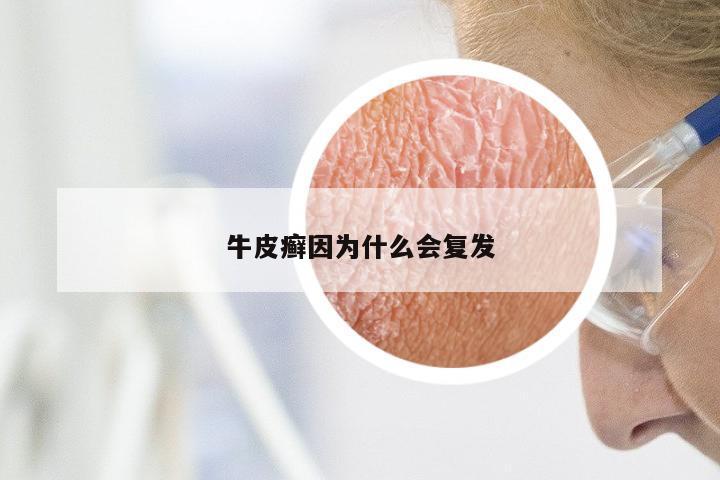 牛皮癣因为什么会复发